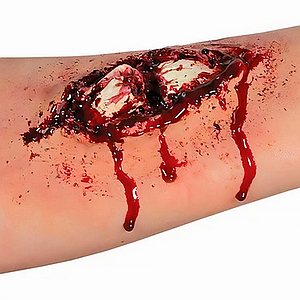 WO163 Prostético de Hueso Roto